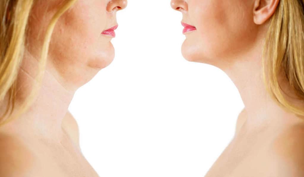 Double Chin treatment Mortlake before and after results