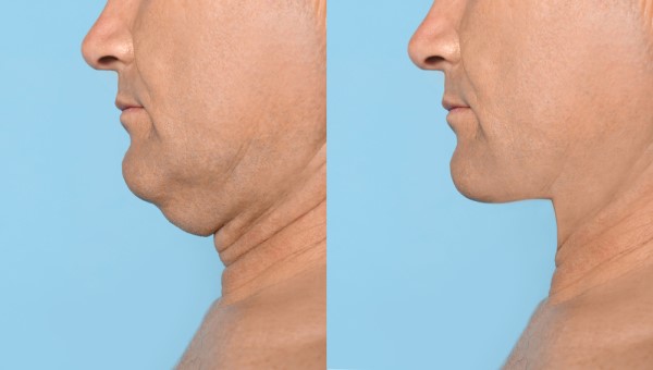 Which Non-Surgical Treatments Work Best for Jowls and Loose Skin Mortlake?