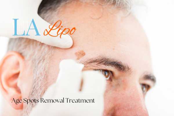 What Are the Most Effective Treatments for Age Spots Mortlake?