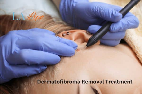 Dermatofibroma Removal Treatment Mortlake