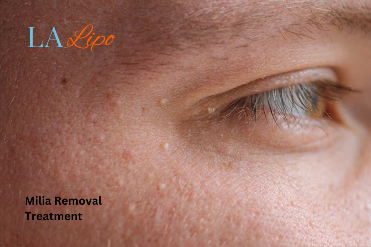 Cryopen Milia Removal: Is It the Easiest and Safest Option Mortlake?
