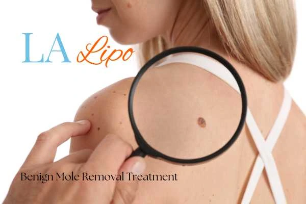 Woman having her inspection of blemish before mole removal Mortlake
