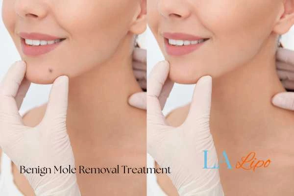 Before and after mole removal Mortlake treatment