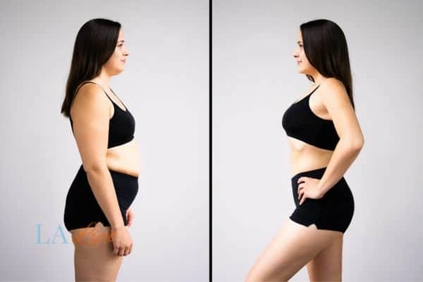 image of woman before and after results of LA-EMS Body Sculpting Mortlake to help treat Diastasis recti