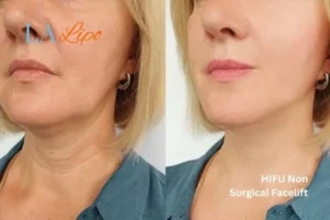 hi-fu for wrinkles Mortlake before and after results