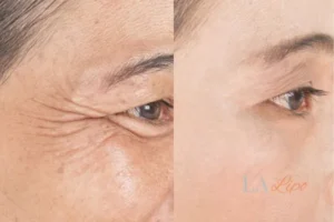 Before and after results of woman - HI-fu wrinkles reduction treatment Mortlake