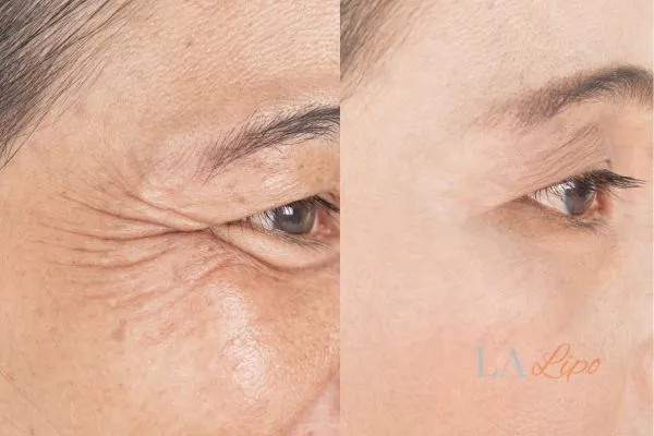 Before and after results of woman - HI-fu wrinkles reduction treatment Mortlake