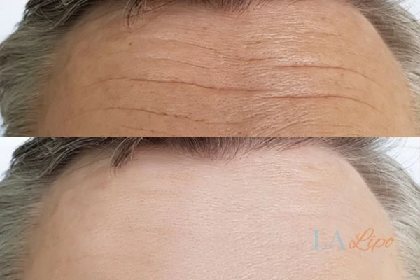 results of HIFU Mortlake on mans forehead to help reduce lines and wrinkles