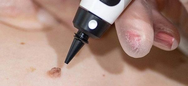 skin tag removal using cryopen Mortlake