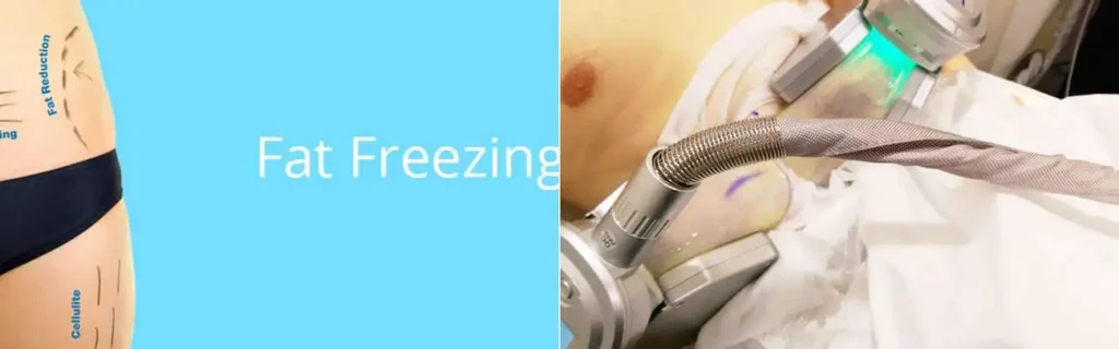 multi areas of a persons body having coolsculpting Mortlake treatment