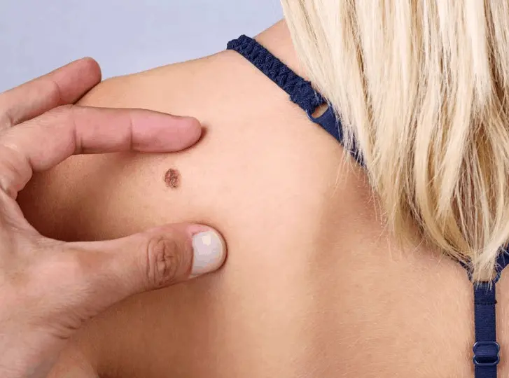 woman having mole removal Mortlake consultation before treatment.