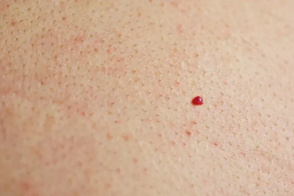 close up of a cherry angioma Mortlake