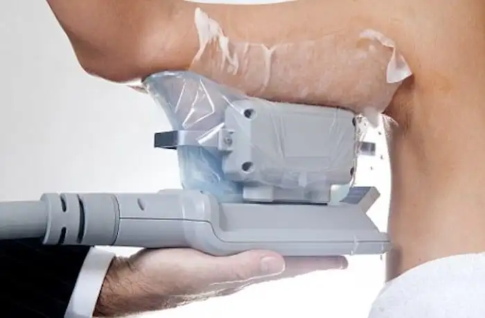 Picture of fat freezing Mortlake on the upper arms.