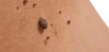 image of a skin tag Mortlake