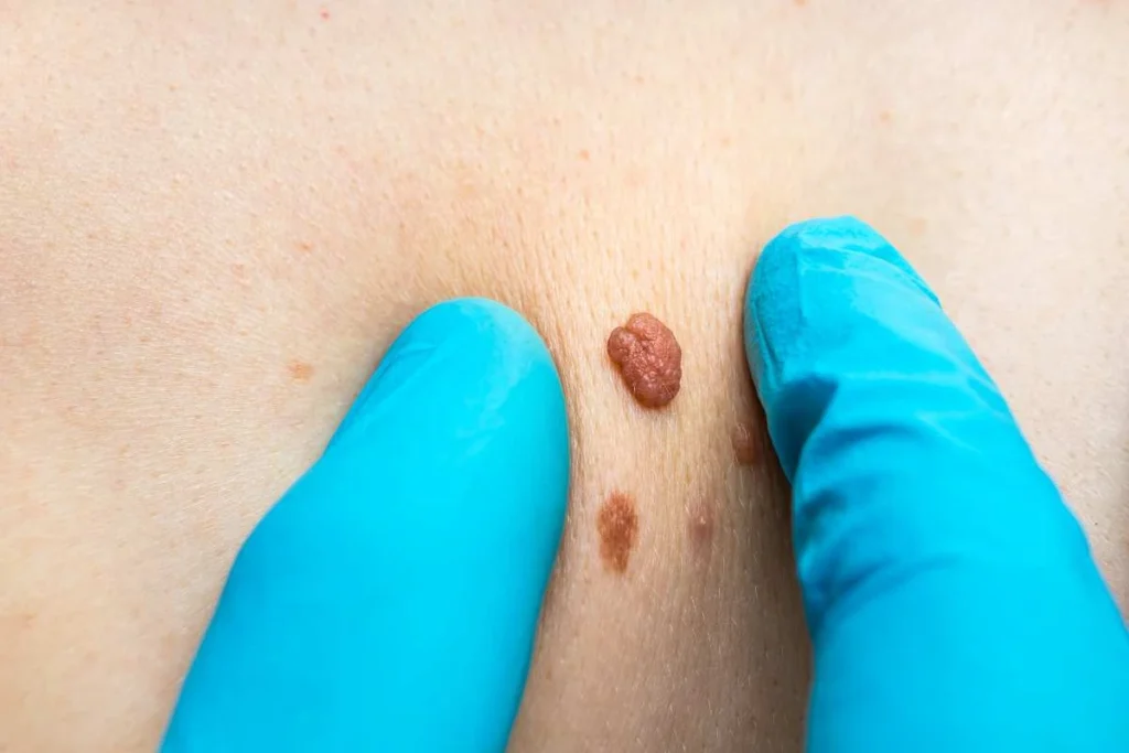 Consultant examining a skin tag Mortlake