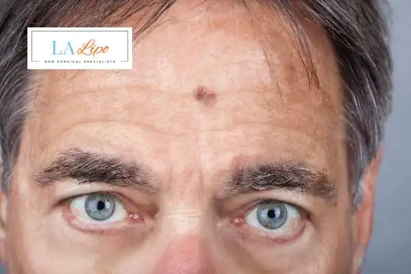 Solar Lentigo Removal Mortlake image of man with mark on his forehead