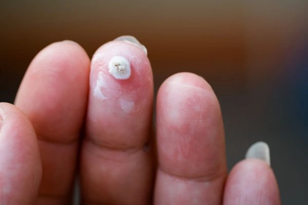 wart on person finger - cryotherapy to treat from LA LIPO Mortlake
