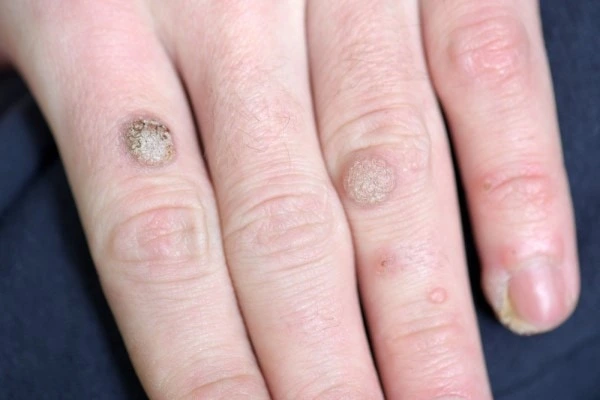 photo of warts on person hand - see wart removal Mortlake from LA LIPO