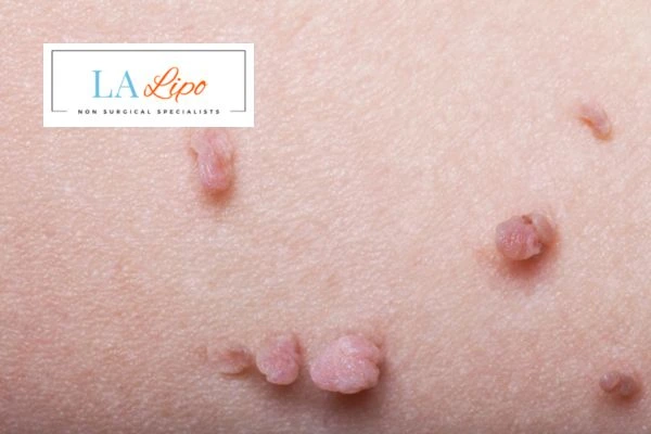 Does cryopen skin tag removal Mortlake hurt? Find out now call our team today!