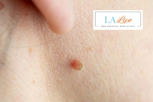 Book skin tag removal Mortlake today speak to our team now!