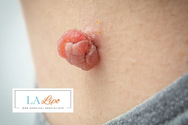 Interested in skin tag removal Mortlake? Concerned about the pain? Find out more today!