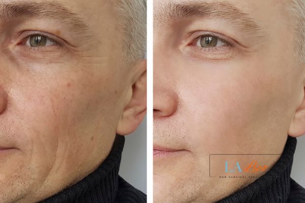 See the amazing results of Morpheus8 Treatment Mortlake!