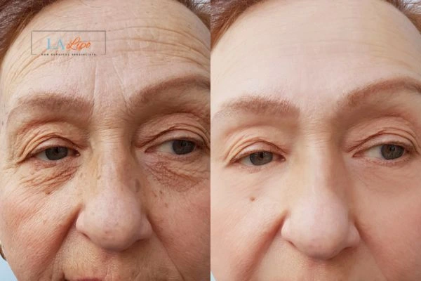 The powerful benefits of Morpheus8 Treatment Mortlake - Call Our team today!