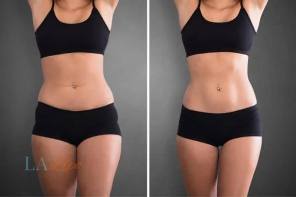 before and after results of non-surgical treatment to help a woman's body image and mental health Mortlake