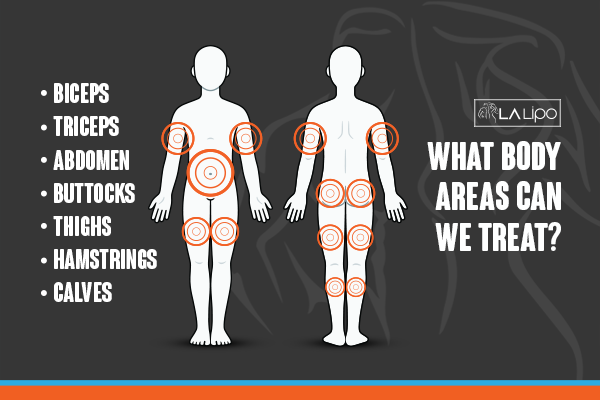 Diagram to show areas you can have LA-EMS Body Sculpting Treatment Mortlake