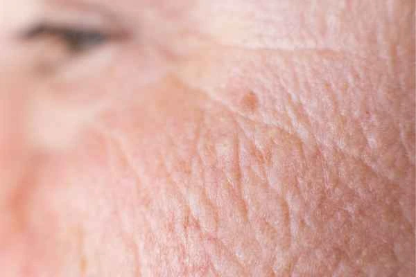 close up picture of a woman's face showing an age spot Mortlake