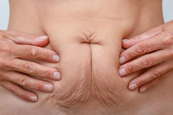 Image of a woman's stomach with loose skin - example of skin tightening Mortlake options