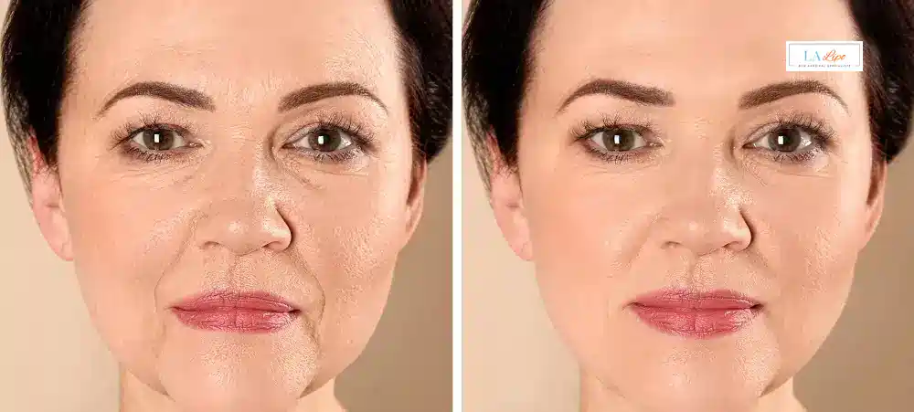 How Long Does It Take to See Results and How Long Do They Last Mortlake?