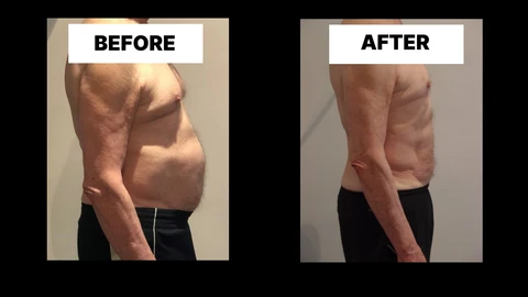 What Symptoms Can Diastasis Recti Cause in Men? Weak Core, Back Pain and Poor Posture Mortlake